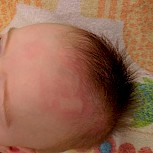 <p>My son suffers from chronic urticaria. We never tried antihistamines, since he doesn´t scratch. However, it´s heartbreaking for parents to see the child covered with weals!</p>