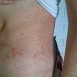 I have this condition for about two years and each day is getting worse.... before never felt itch but now is every days an the itch is  moderate to severe. To tell the truth I do not know what to do, I used to take loratadine and sometimes when the...